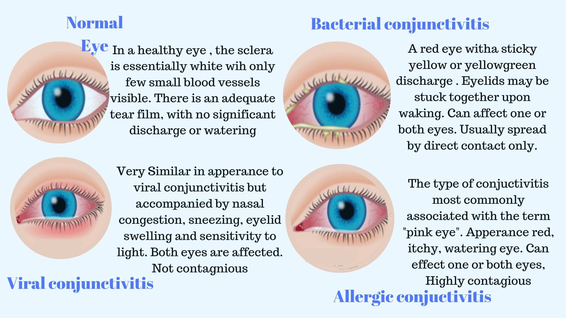 eye flu treatment। Conjuctivitis Prevention and treatment