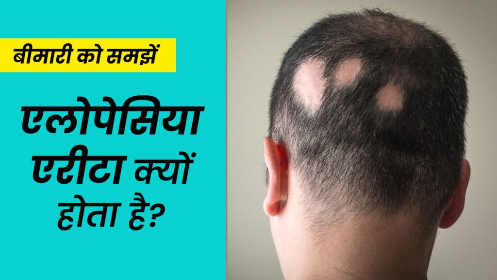 Alopecia Areata Causes