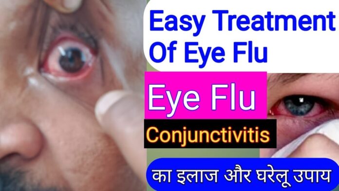 eye flu treatment। Conjuctivitis Prevention and treatment