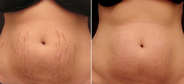 Laser Treatment for Stretch Mark Removal