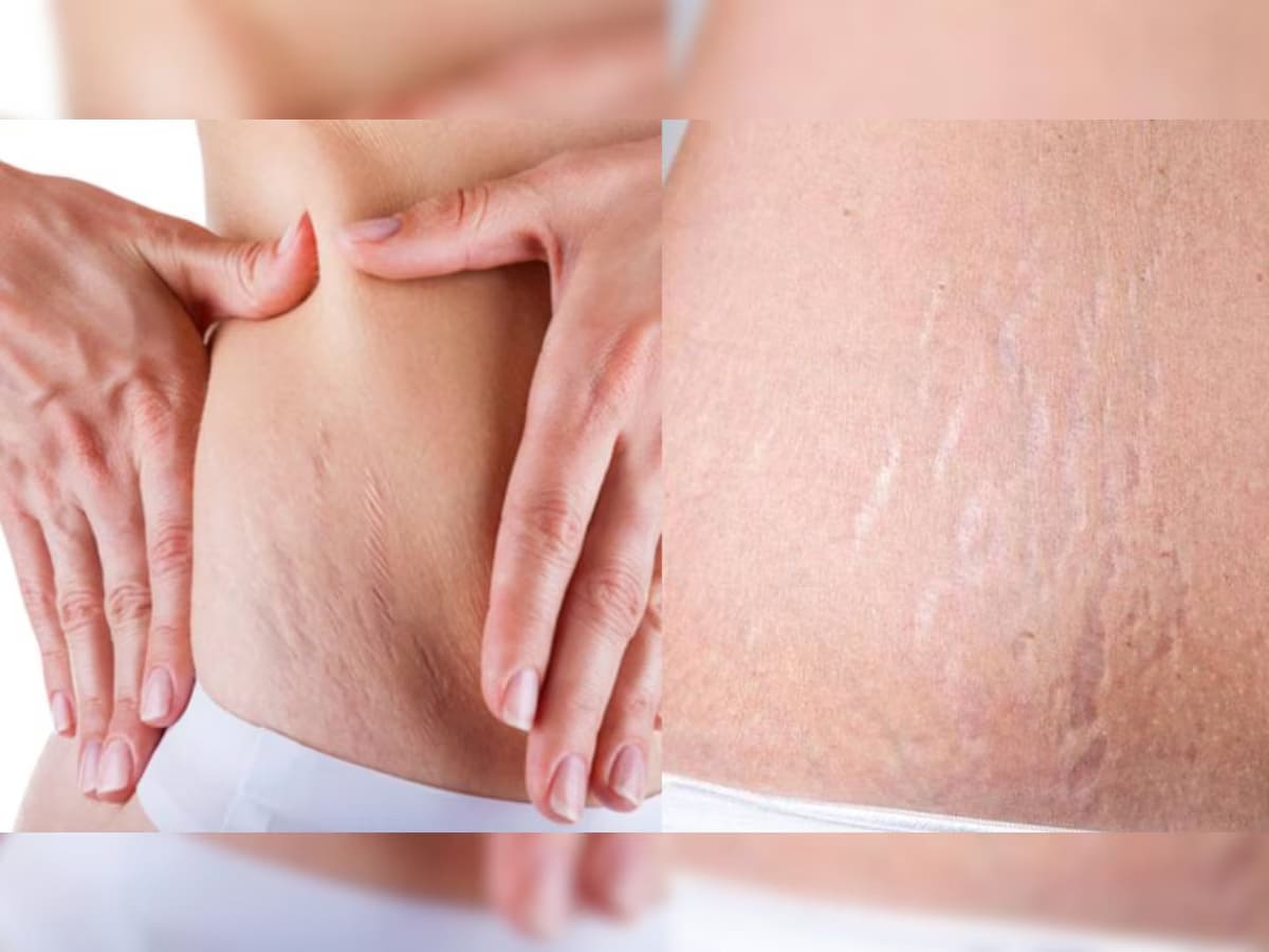 Stretch Marks Man Cosmetic Surgery